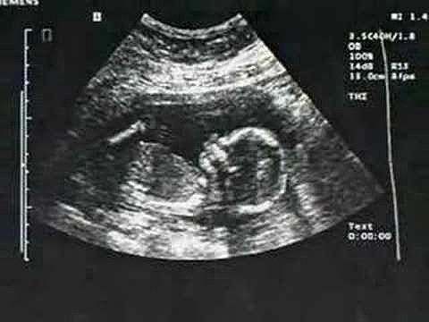 VIDEO DEL ABORTO MUY FUERTE