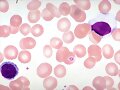 Cient&iacute;ficos identifican gen de la leucemia